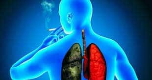 El cáncer de pulmón, primera causa de muerte oncológica en el país, podría aumentar casi un 80% para 2050
