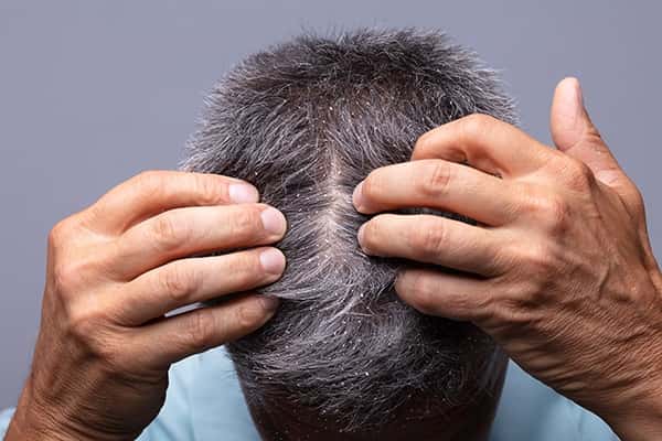 ¿Cuál es el tratamiento contra la caspa en el cabello?