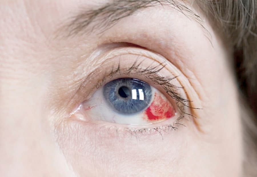 Glaucoma: Una enfermedad que afecta a 1 millón de argentinos