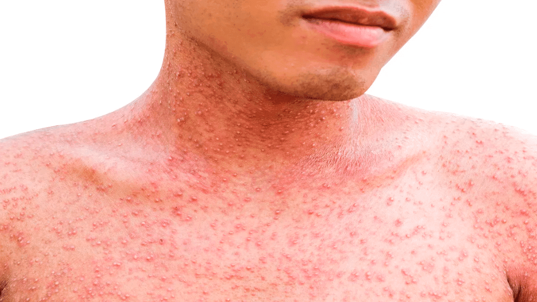 Alerta epidemiológica por nuevos casos de sarampión