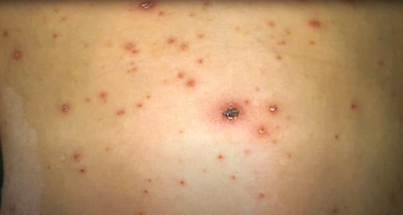 Zona de alerta por brote de varicela en Tierra del Fuego