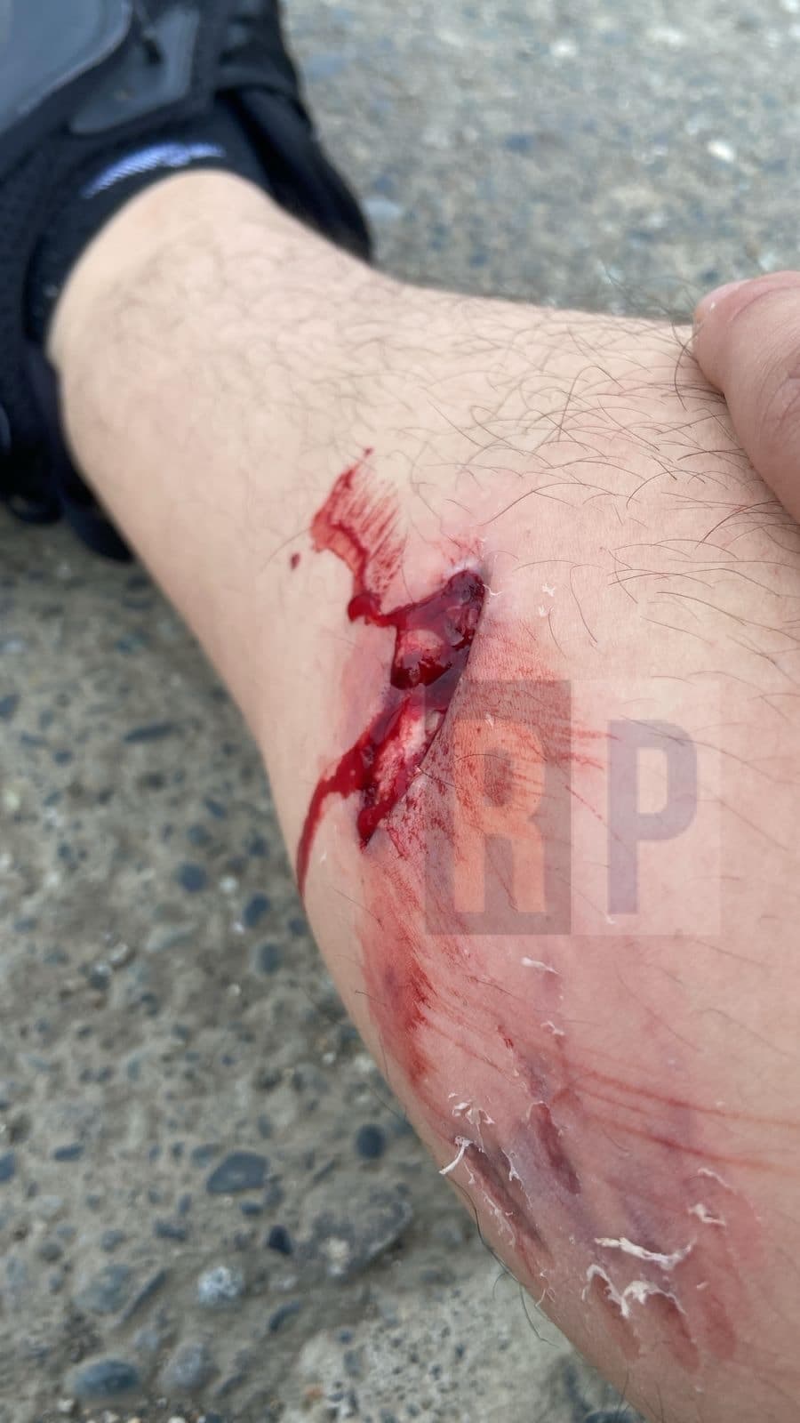 Grave ataque de un pitbull a un joven y denuncia contra los propietarios